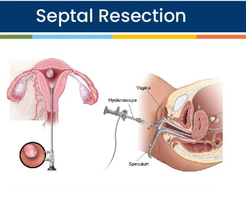 Septal resection  image 1