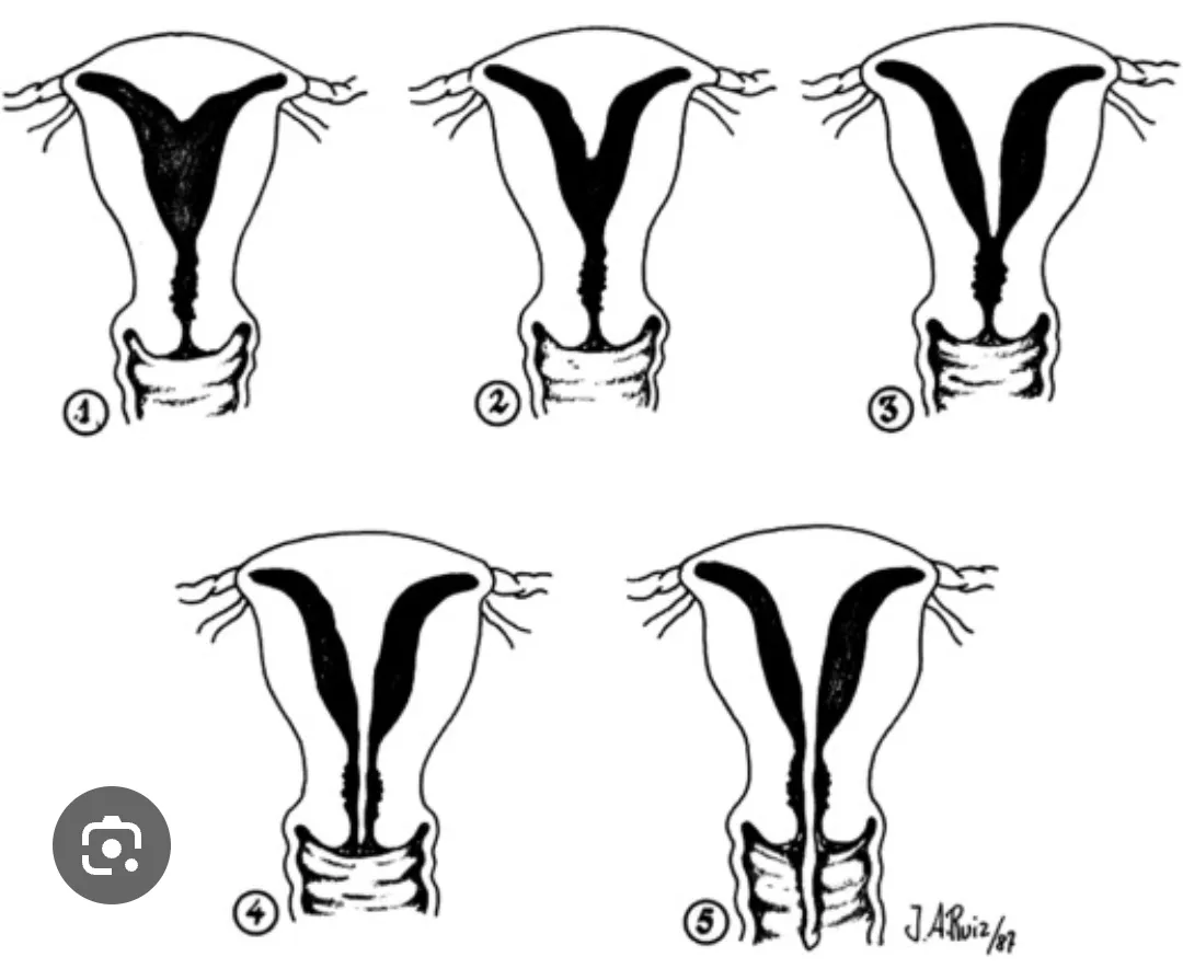 Metroplasty image 1
