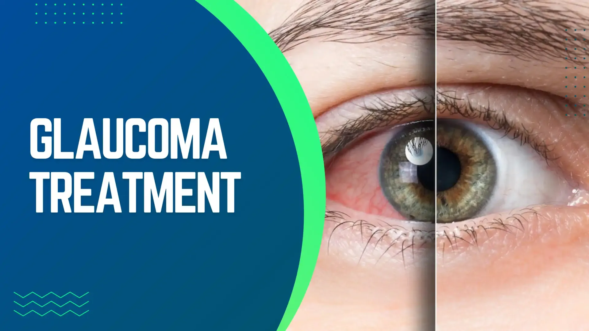 Glaucoma Treatment in Thane image 1