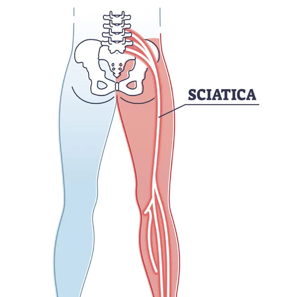 Sciatica Treatment image 1