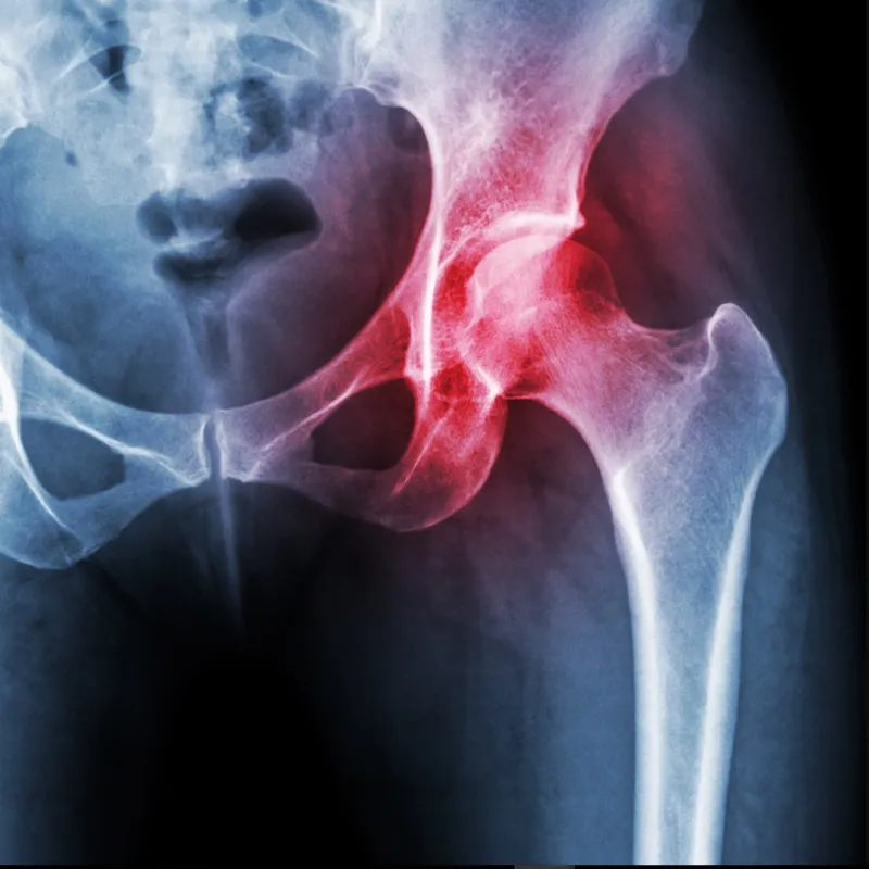 AVN Non-Surgical Regenerative Program Treatment image 1