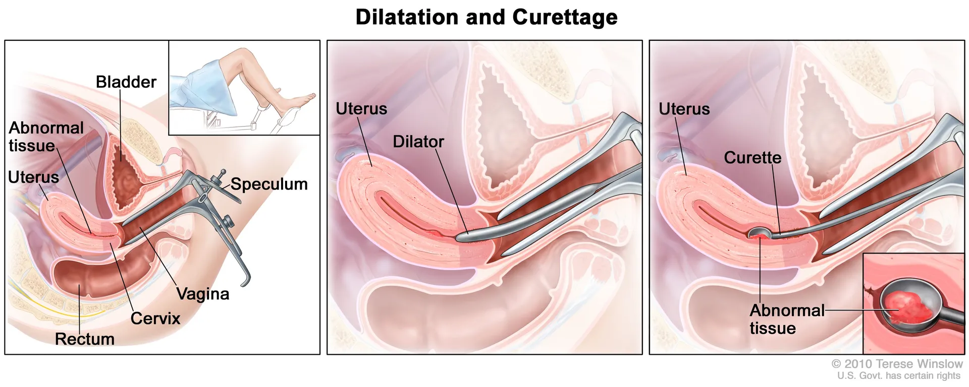  Dilation and Curettage image 1