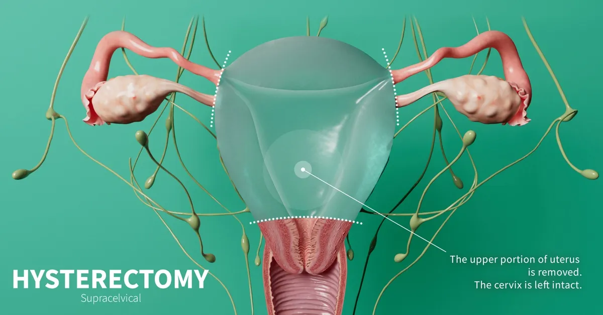 Hysterectomy image 1