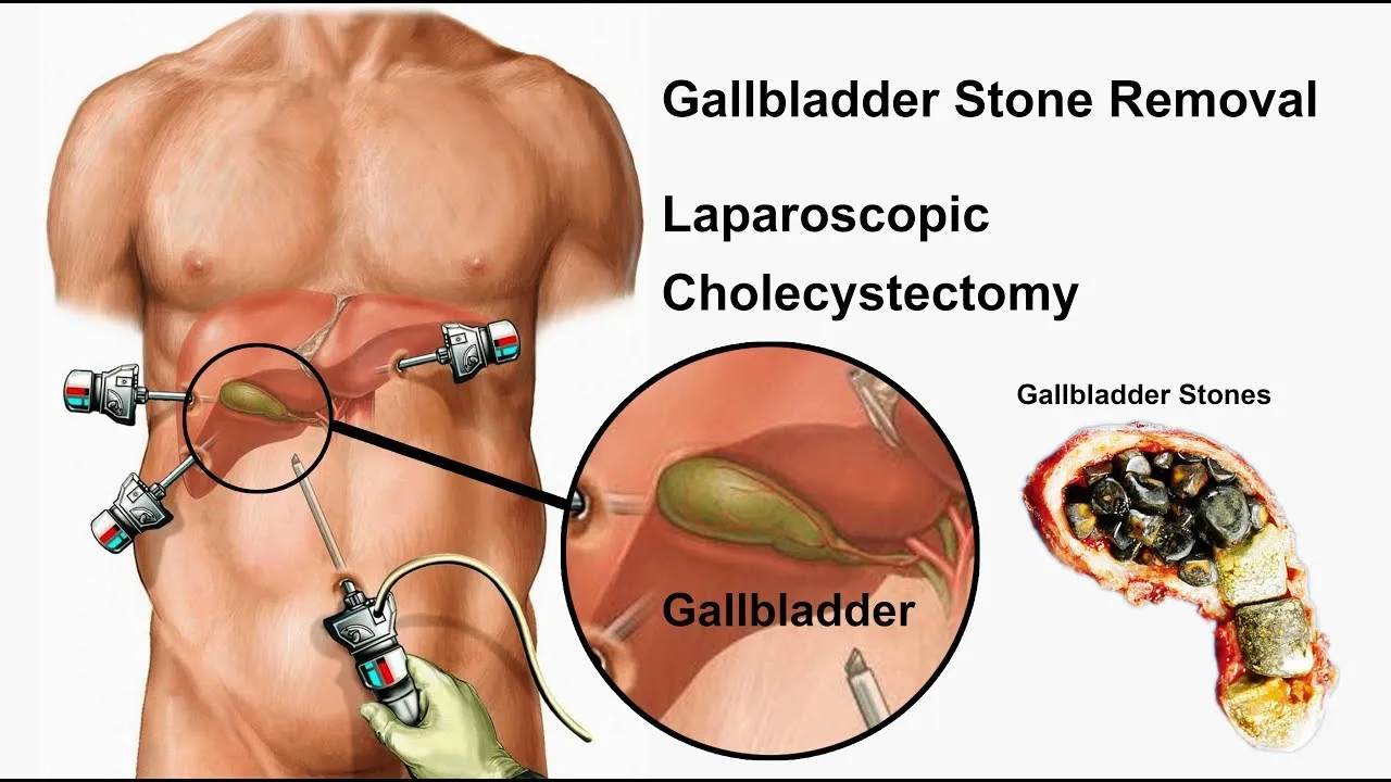 Gall Bladder Stone Surgery  image 1