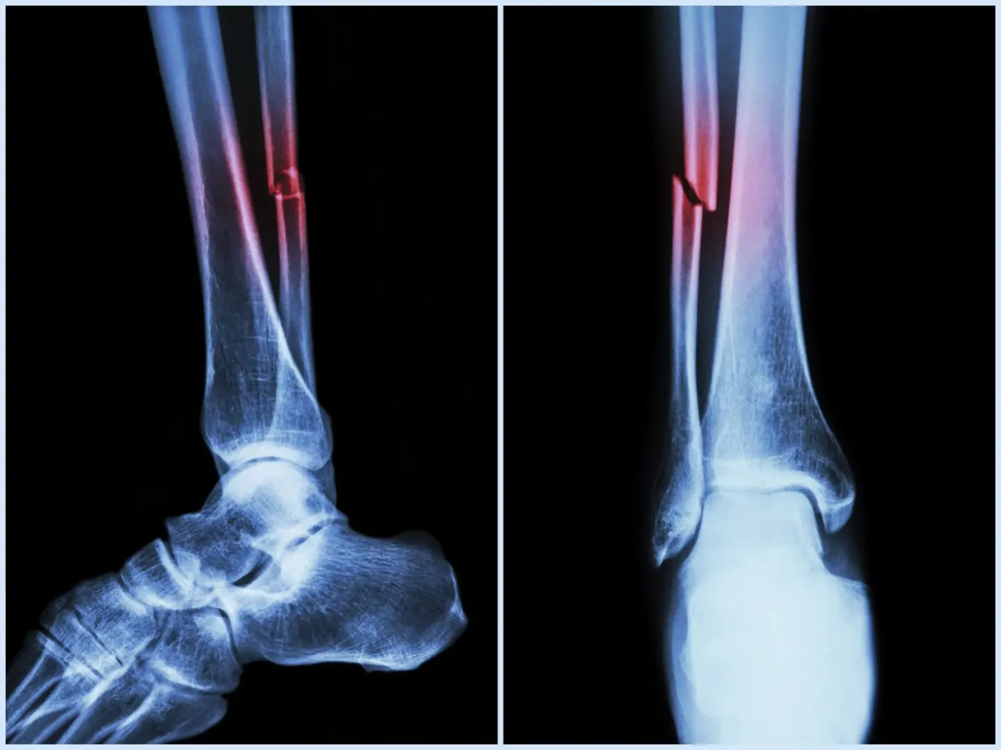 Fractures Treatment & Surgery image 1
