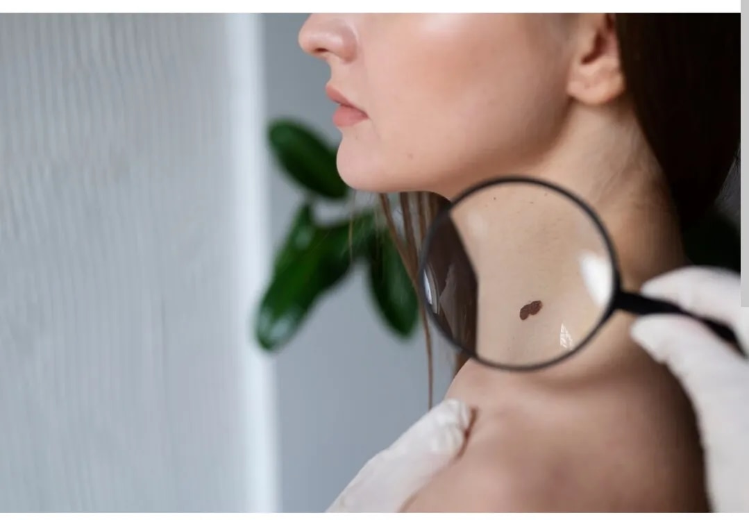 Skin Tag Removal
 image 1