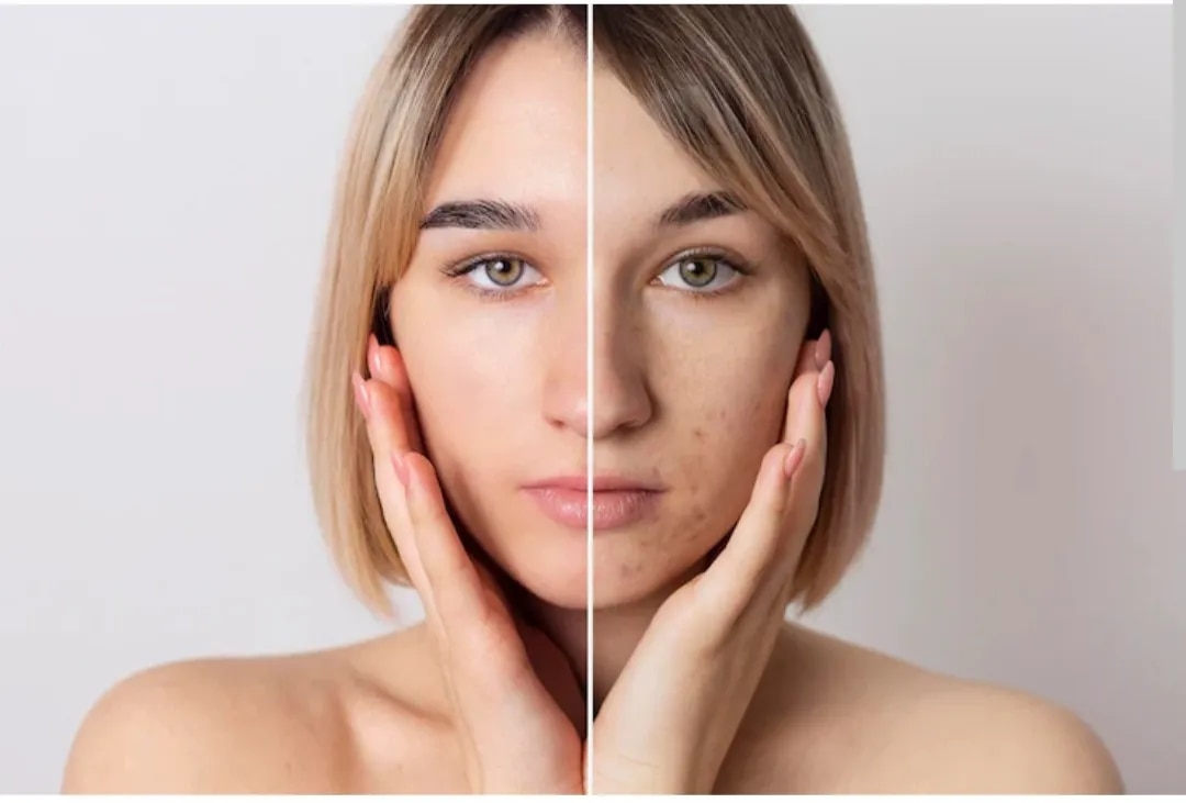 Acne Scar treatment
image 1
