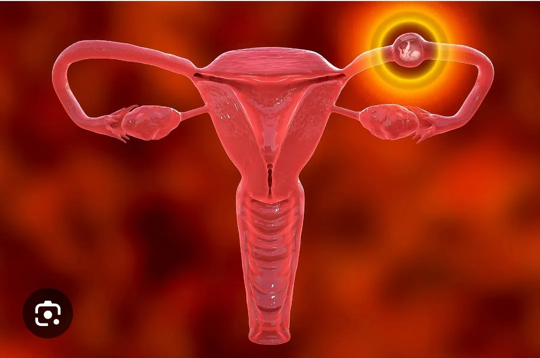Ectopic pregnancy  image 1