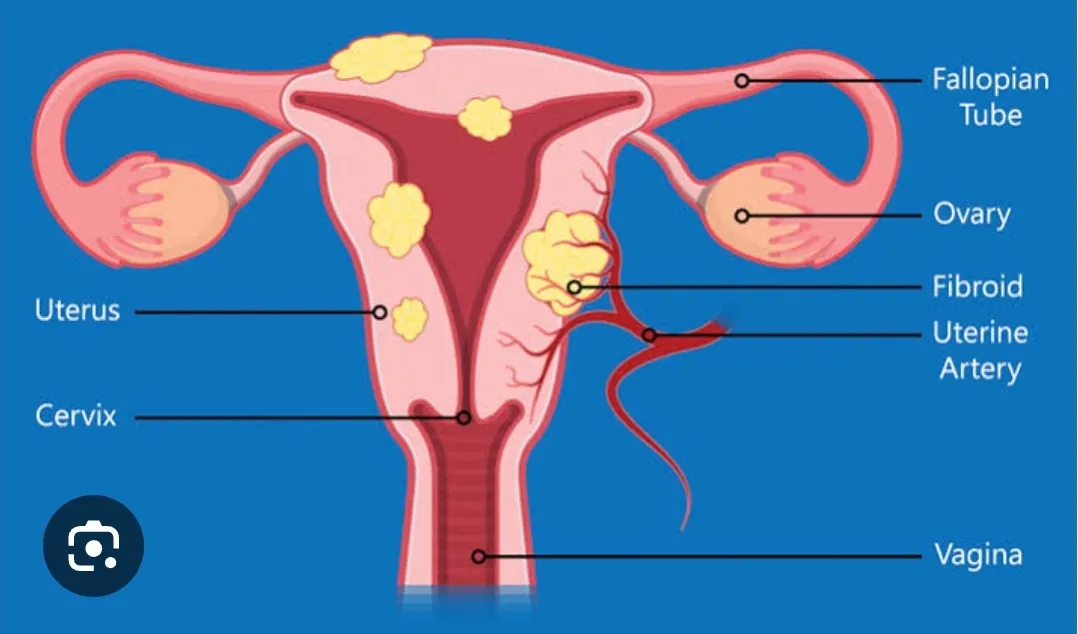 Myomectomy  image 1
