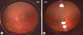Retinal check up in Thane image 1