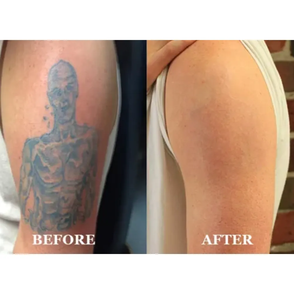 Tattoo Removal Treatment image 1