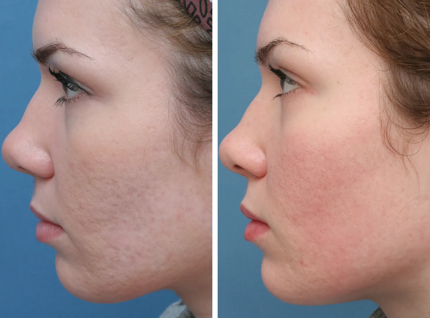 Scars Treatment image 1