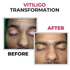Vitiligo Treatment image 1