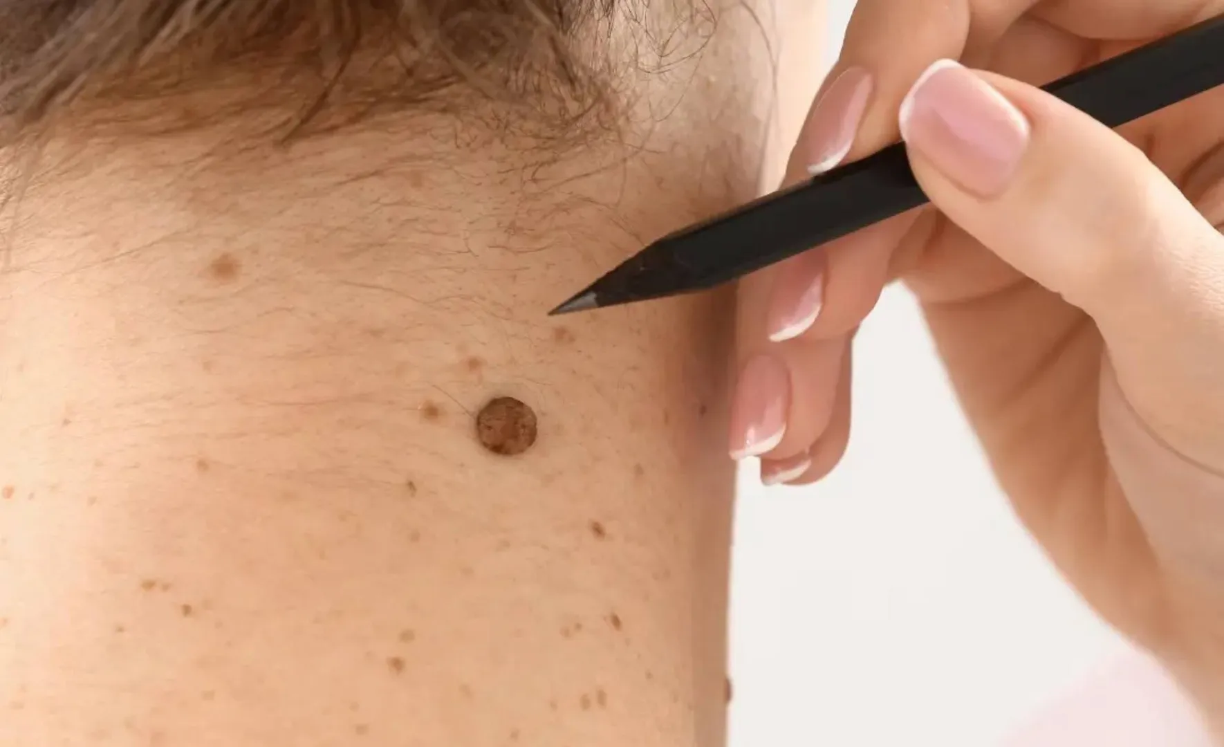 Warts & Moles Removal Treatment image 1