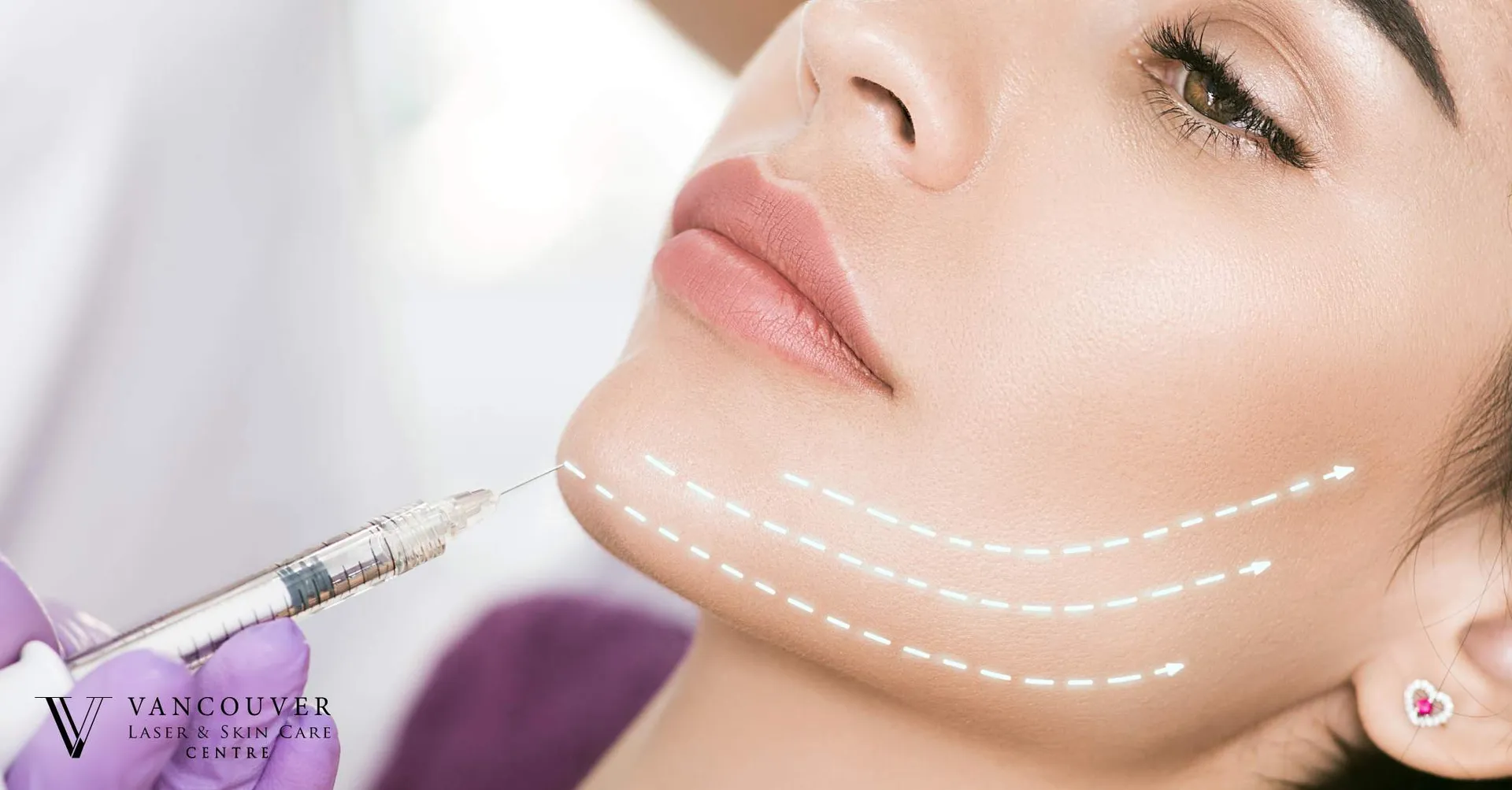 Non-Surgical Facelift Treatment image 1