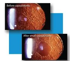 YAG Capsulotomy in Thane image 1
