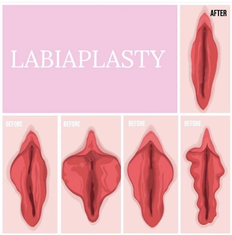 Labiaplasty image 1