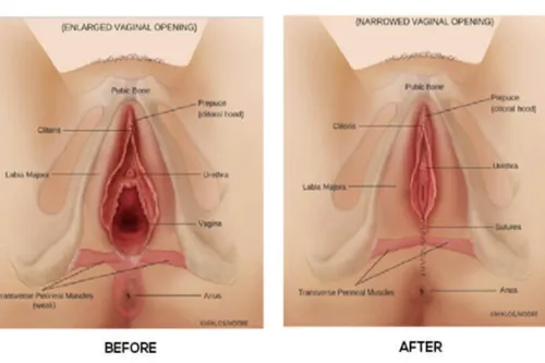 Vaginal Tightening Procedures image 1