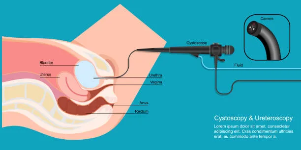 Cystocele & Rectocele Repair image 1