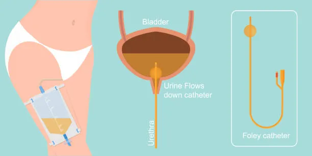 Urinary Incontinence Management image 1