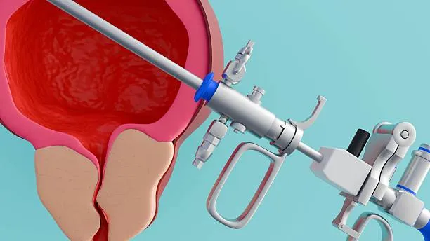 Polypectomy / Myomectomy image 1