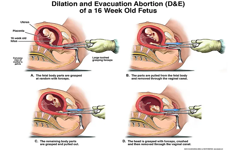 Medical termination of pregnancy (abortion services) image 1