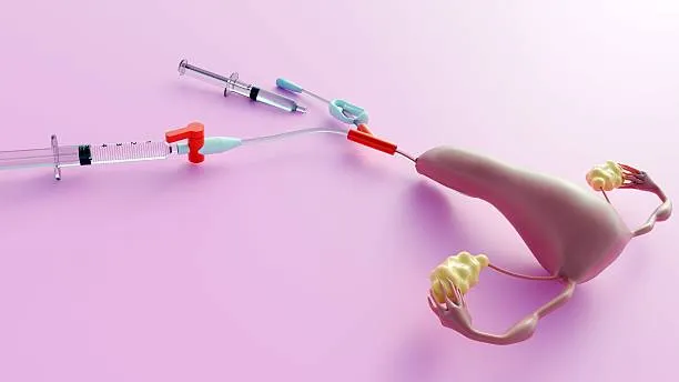 IUI (Intrauterine Insemination) image 1