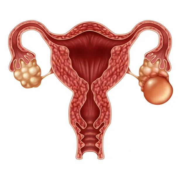 Fibroids, ovarian cysts & endometriosis image 1