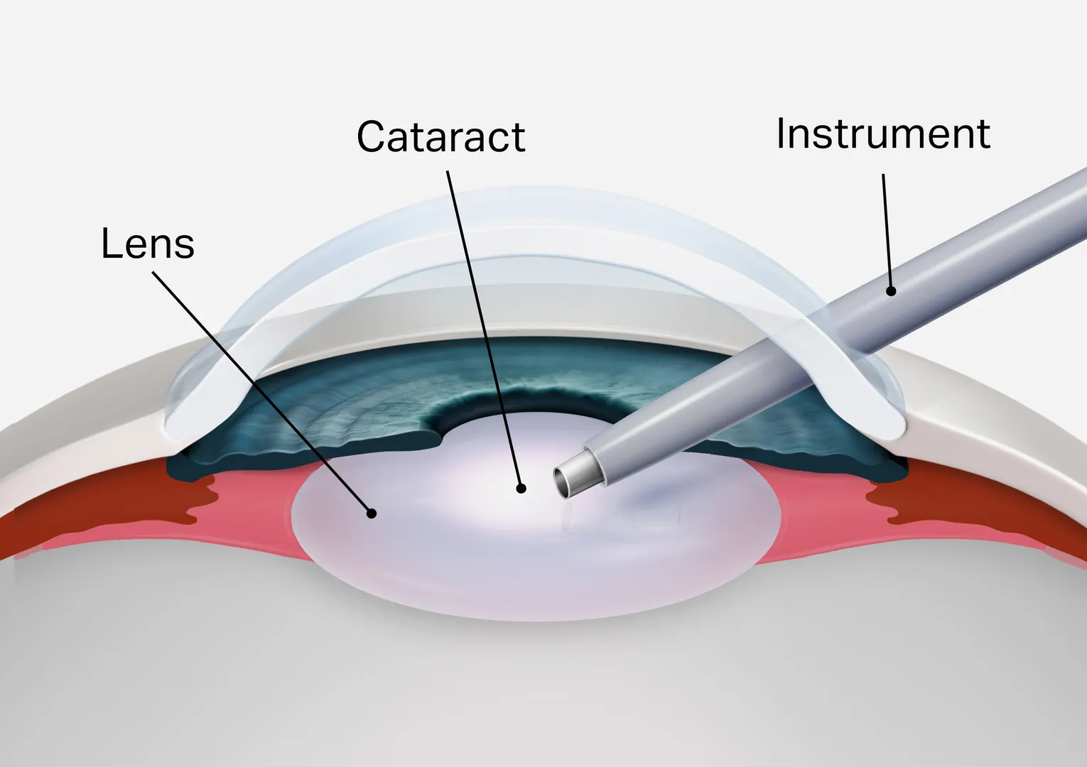 Cashless Cataract Surgery Consultation image 1