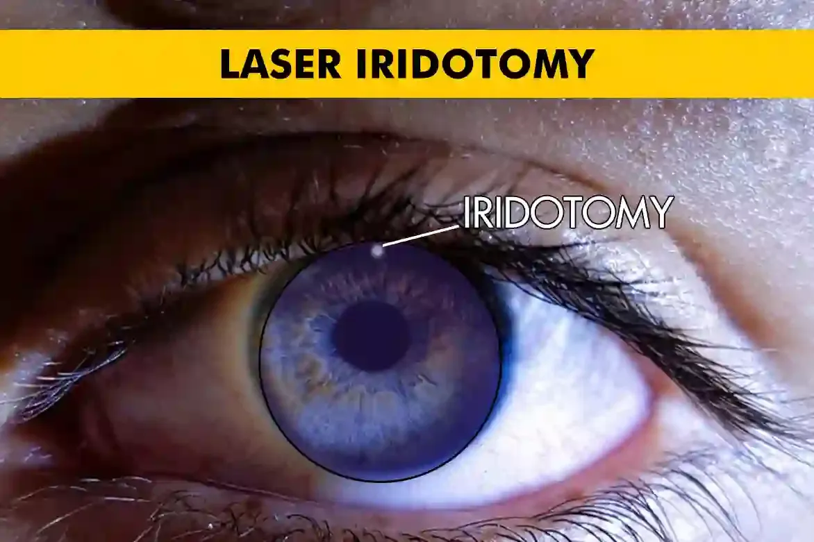 YAG LASER Peripheral Iridotomy image 1