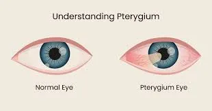  Pterygium Management image 1