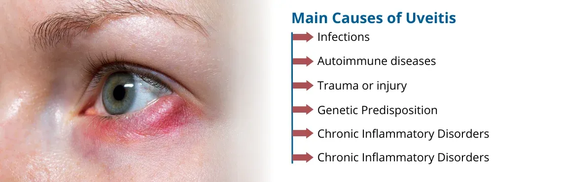  Uveitis Management  image 1