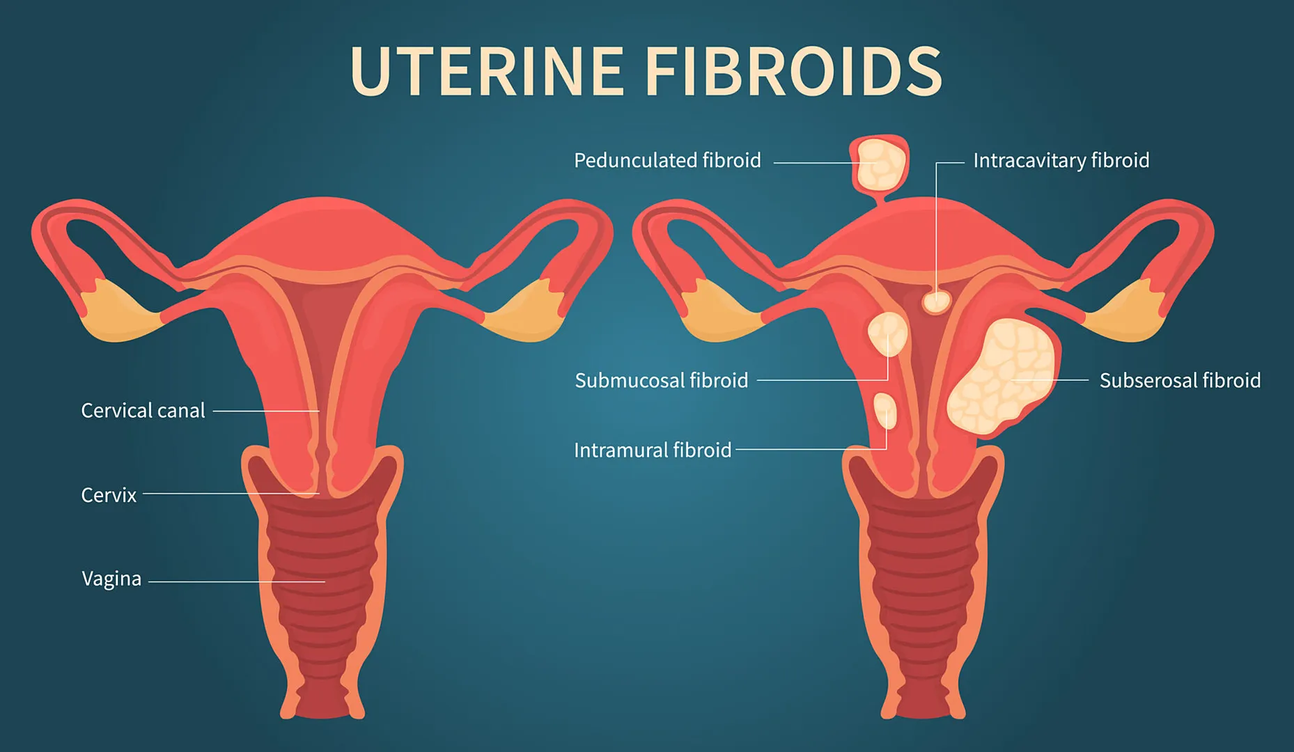 Fibroids Treatment image 1