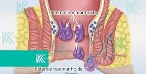 Laser treatment for piles (hemorrhoids) image 1
