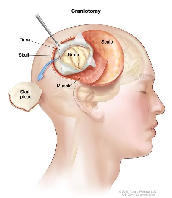 Craniotomy  image 1