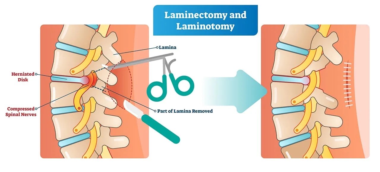 Laminectomy ( Decompression Surgery) image 1