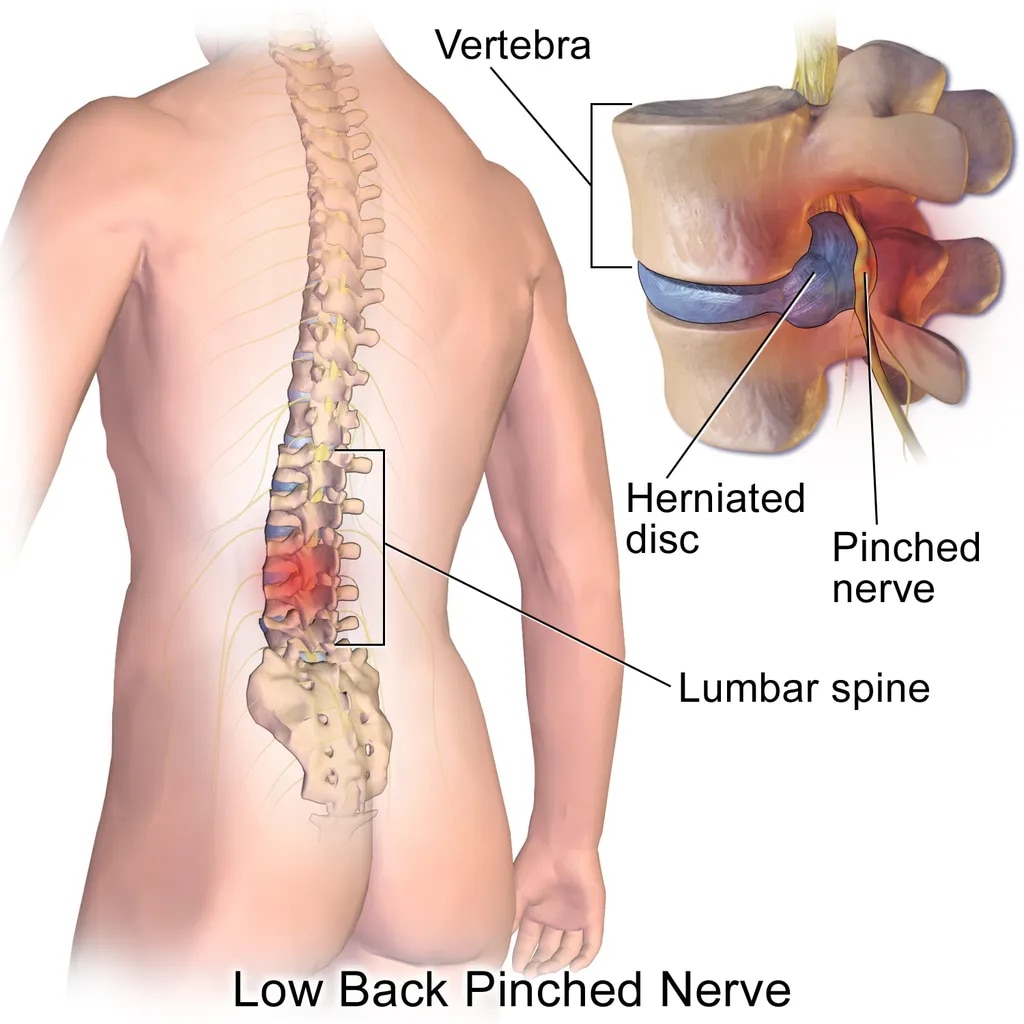 Microdiscectomy  image 1