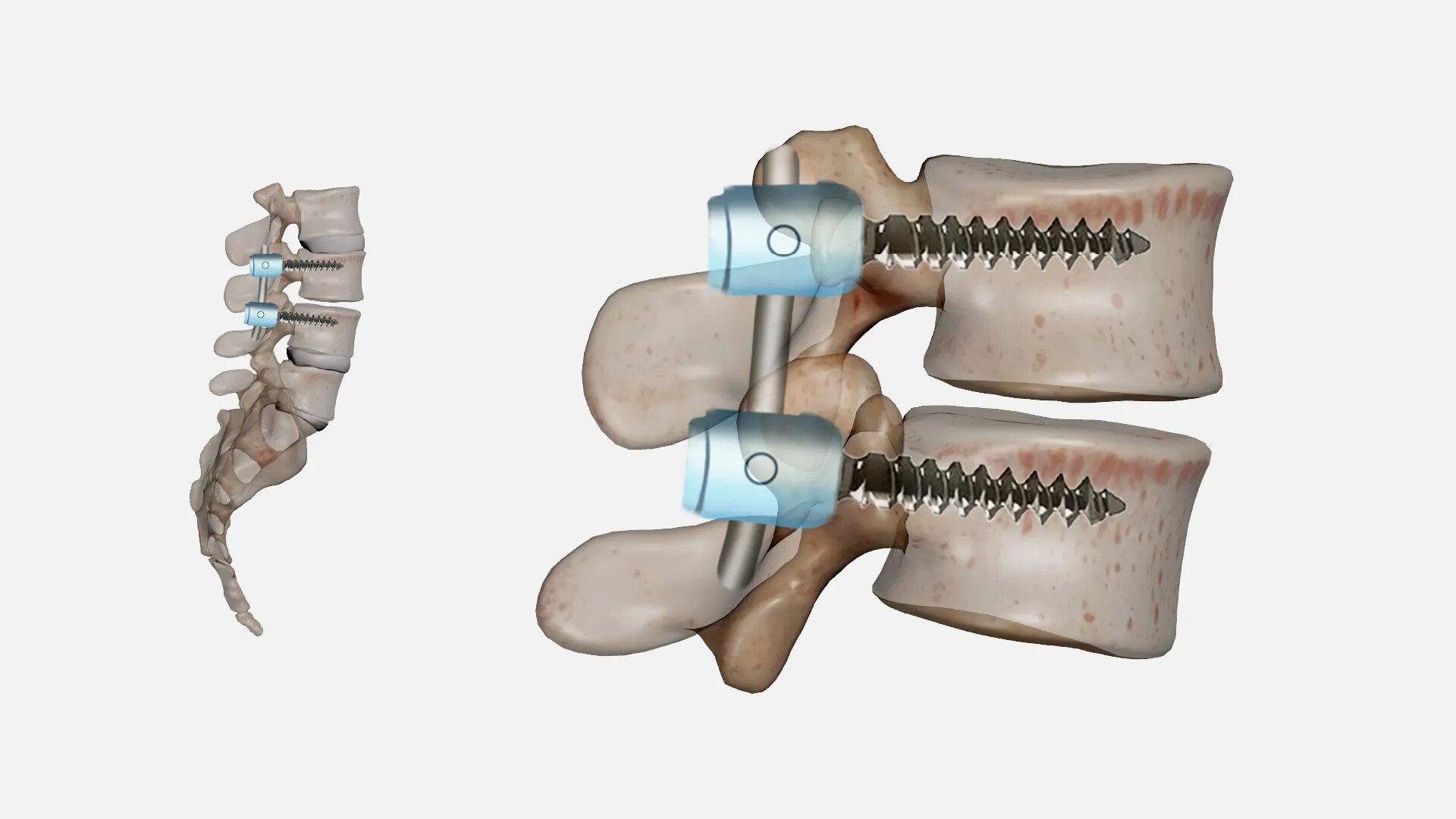 Spinal Fusion  image 1