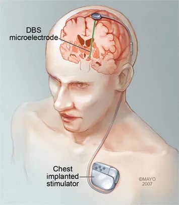 Deep Brain Stimulation (DBS) image 1