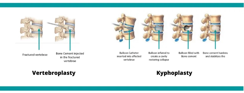 Vertebroplasty/Kyphoplasty  image 1