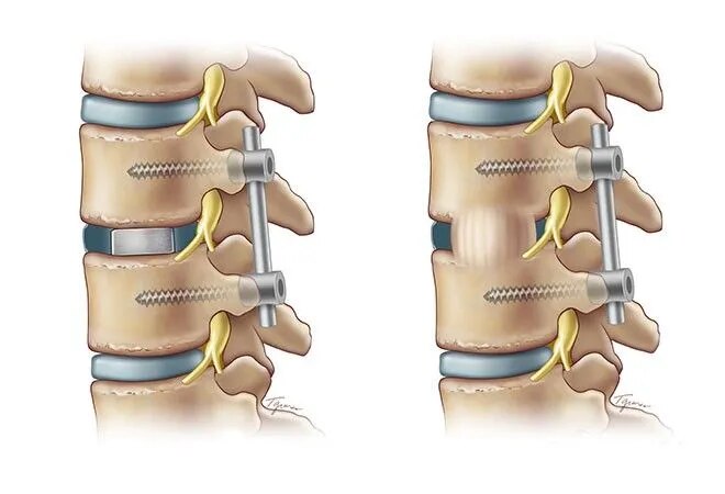 TLIF Treatment for Chronic Lower Back Pain image 1
