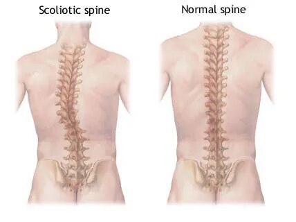 Advanced Spinal Deformity Correction Surgery In Jaipur image 1