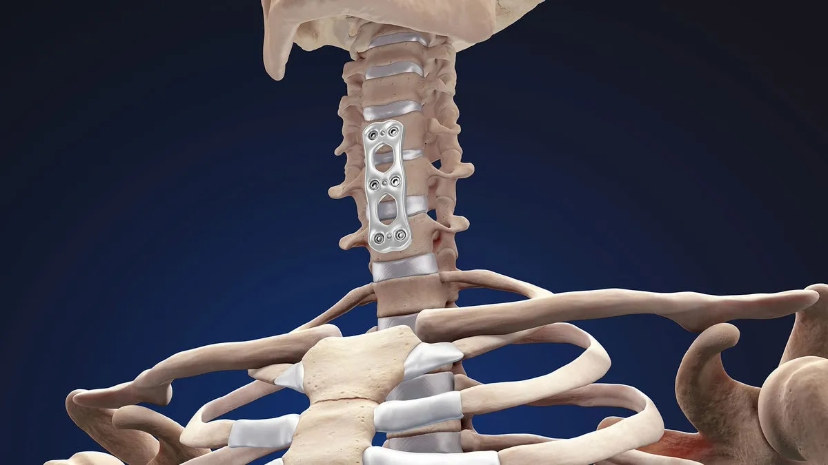 ACDF (Anterior Cervical Discectomy and Fusion): Modern Neck Spine Surgery image 1