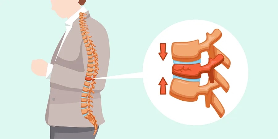 Spine Fracture Fixation Surgery For Spinal Stability image 1