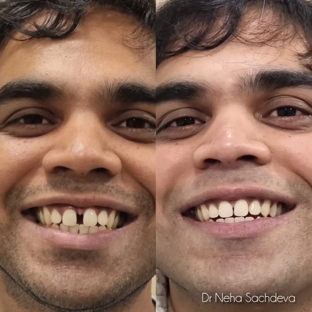 Invisalign  image 1