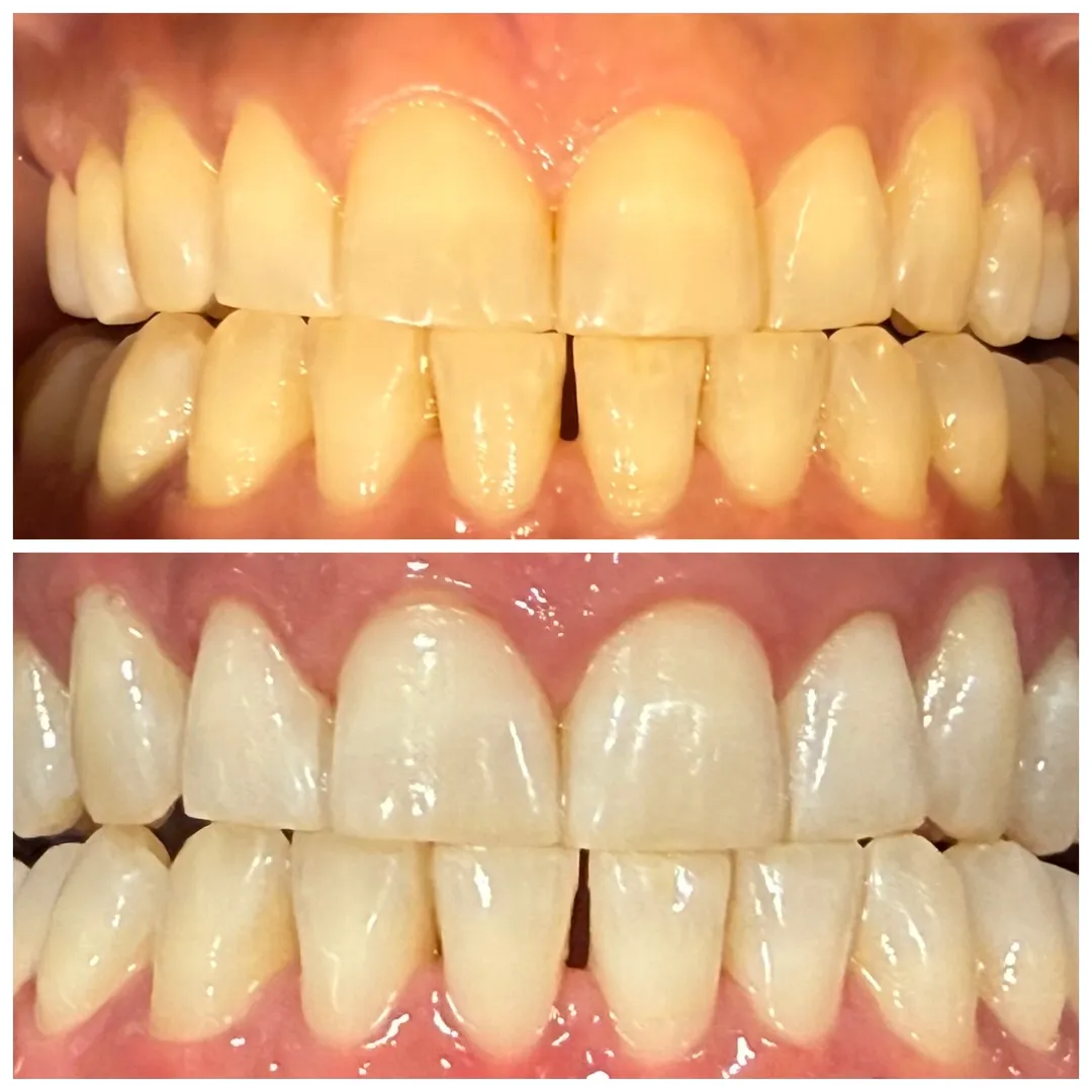 Teeth Whitening image 1