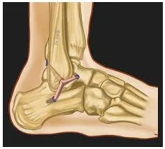 Tendon and Ligament Reconstruction image 1