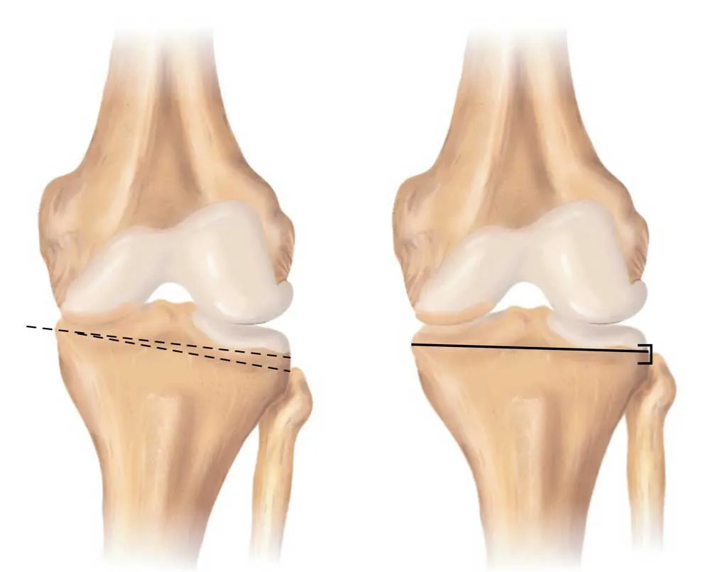 Osteotomy image 1