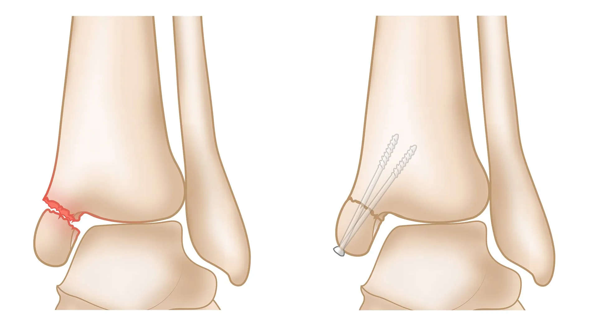Fracture Repair image 1