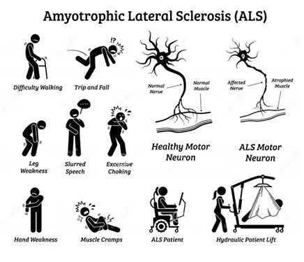 Motor Neuron Diseases (including ALS) image 1